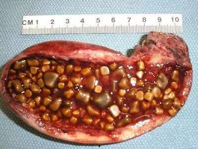 胆结石吃白瓜,白瓜助力健康生活